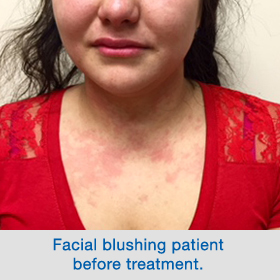 Facial blushing patient before treatment